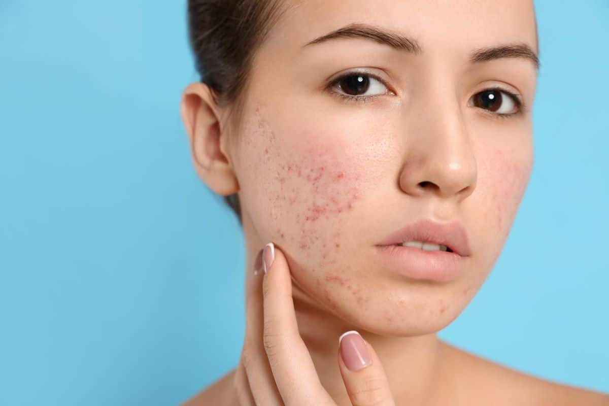 Girl with acne on skin